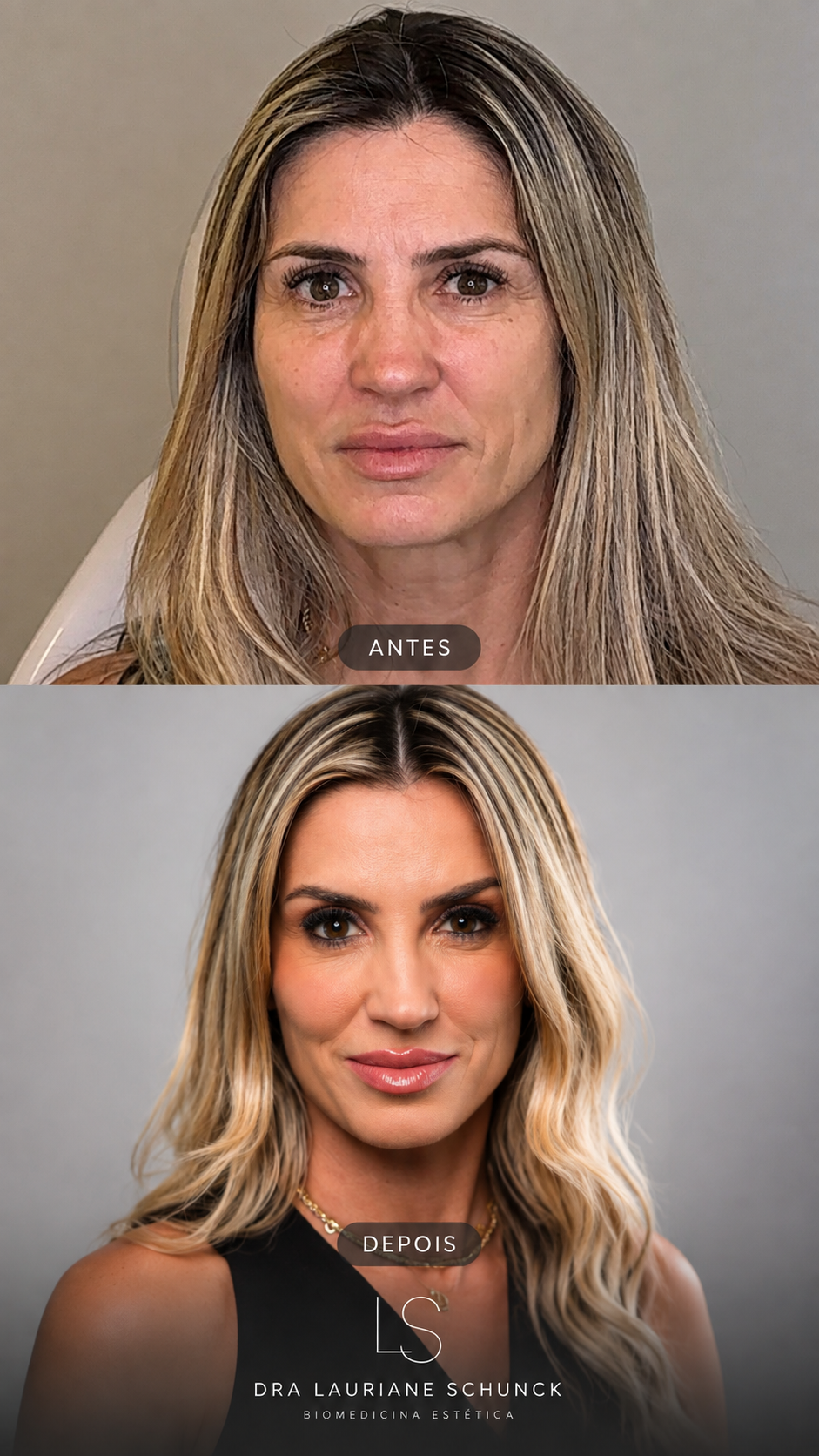 Resultado do Protocolo Elegance — caso 7
